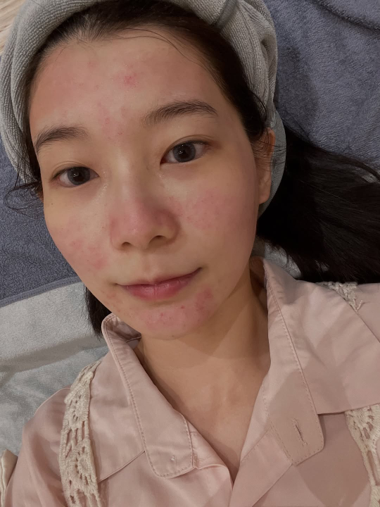 植泌體導入:讓恢復期縮短、修護力放大